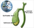Gallbladder Surgery