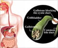 Gallstones (Cholelithiasis) - Causes - Symptoms - Diagnosis - Treatment - FAQs