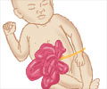 Gastroschisis-Incidence-Surgery-Obstacle-Recovery-Long Term Problem