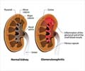 Glomerulonephritis