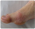 Drugs for Treatment of Gout