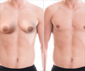 Gynecomastia - Causes, Symptoms, Diagnosis, Treatment, Prevention Gynecomastia - Causes, Symptoms, Diagnosis, Treatment, Prevention