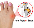 Halus Valgus | Halus Abducto Valgus | Bunions - Causes Symptoms Diagnosis Treatment Halus Valgus | Halus Abducto Valgus | Bunions - Causes Symptoms Diagnosis Treatment