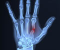 Hand Fractures – Causes, Symptoms, Diagnosis, Treatment Hand Fractures – Causes, Symptoms, Diagnosis, Treatment