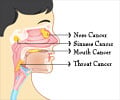 Head and Neck Cancers - Types, Risk Factors, Symptoms, Diagnosis, Treatments Head and Neck Cancers - Types, Risk Factors, Symptoms, Diagnosis, Treatments