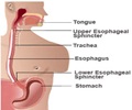 Reflux Esophagitis Reflux Esophagitis
