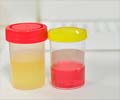 Hematuria or Blood in the Urine - Causes, Symptoms, Treatment, Risk Factors, Prognosis & Prevention