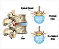 Herniated Disc - Causes, Symptoms, Diagnosis, Treatment, Complications, Prevention & Prognosis Herniated Disc - Causes, Symptoms, Diagnosis, Treatment, Complications, Prevention & Prognosis