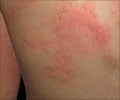 Hives / Urticaria - Symptom Evaluation Hives / Urticaria - Symptom Evaluation