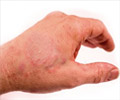 Eczema: Miracles with Homeopathy