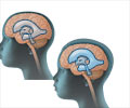 Hydrocephalus - Types, Causes, Symptoms, Diagnosis, Treatment, Health Tips