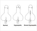Hypospadias - Causes, Symptoms, Diagnosis, Treatment