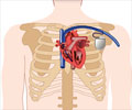 Implantable Cardioverter Defibrillator - Indications, Advantages and Risks