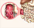Inflammatory Bowel Disease - Causes, Symptoms, Diagnosis, Treatment & Prevention