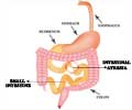 Intestinal Atresia - Types, Causes, Symptoms, Diagnosis and Treatment