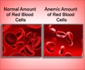Anemia- Iron Deficiency: Causes, Symptoms & Treatment