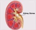 Kidney Stones / Renal Stones - Causes - Symptoms - Diagnosis - Treatment - FAQs
