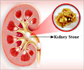 Kidney Stone Prevention