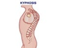 About Kyphosis
