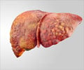 How to Prevent Spread of Colorectal Cancer Cells to Liver? Research ...