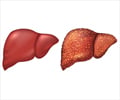 Liver Cirrhosis - Causes, Symptoms, Diagnosis, Treatment & Prevention