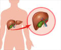 Liver Transplantation - Facts, Contraindications, Procedure, Follow up, Complications & Prognosis