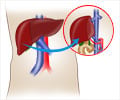 Living Donor Liver Transplant: What Are the Risks?