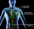 Burkitt’s Lymphoma - Symptoms - Signs - Diagnosis - Treatment - FAQs
