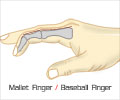 Mallet Finger