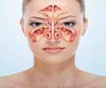 Cancer of Maxillary Sinus/Paranasal Sinuses-Symptoms-Diagnosis-Treatment-Prevention