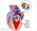 Mitral Valve Stenosis And Mitral Valve Replacement - Brief Information