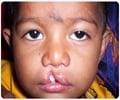 Multifactorial Birth Defects - A Cleft Lip And Cleft Palate