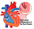 Myocarditis - Types, Causes, Symptoms, Complications, Treatment, Prognosis
