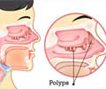 Nasal Polyp - Causes, Symptoms, Diagnosis, Treatment, Health Tips Nasal Polyp - Causes, Symptoms, Diagnosis, Treatment, Health Tips