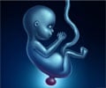 Neural Tube Defects - Types, Causes, Diagnosis & Treatment Neural Tube Defects - Types, Causes, Diagnosis & Treatment