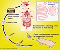 Neurocysticercosis / Cysticercosis of Brain / Pork Tapeworm - Causes Symptoms Diagnosis Treatment FAQs