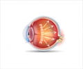 Ocular Hypertension - Causes, Symptoms, Diagnosis, Treatment & Prevention