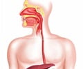 Oesophageal Atresia / Tracheo Oesophageal Fistula