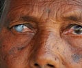 Onchocerciasis | River Blindness - Causes, Symptoms, Diagnosis, Treatment, Prevention Onchocerciasis | River Blindness - Causes, Symptoms, Diagnosis, Treatment, Prevention