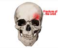 Orbital Fractures | Fractures of the Orbit | Eye Socket Fractures