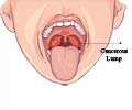Oropharyngeal Cancer