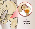 Osteomyelitis