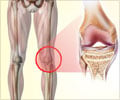 Osteoporosis-Causes-Symptoms-Diagnosis-Treatment-FAQs