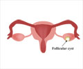 Ovarian Cysts
