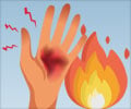 Pain Management for Burn Injuries
