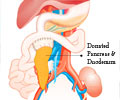 Pancreas Transplantation - Procedure, Evaluation, Preparation, Surgery, After care