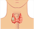 Papillary Thyroid Cancer - Types, Risk Factors, Diagnosis, Treatment
