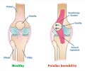 Patellar Instability Patellar Instability