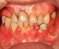 Periodontitis | Pyorrhea | Periodontal Gingivitis - Causes, Risk Factors, Symptoms, Diagnosis & Treatment
