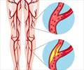 Peripheral Artery Disease (PAD) - Causes, Symptoms, Diagnosis, Treatment & Prevention